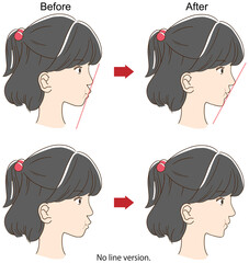 歯列矯正をした女児の横顔ビフォーアフターイメージ