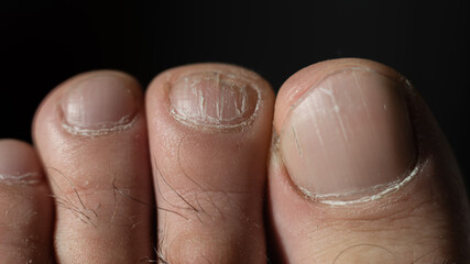 Close-up of male toes with a cracked nail