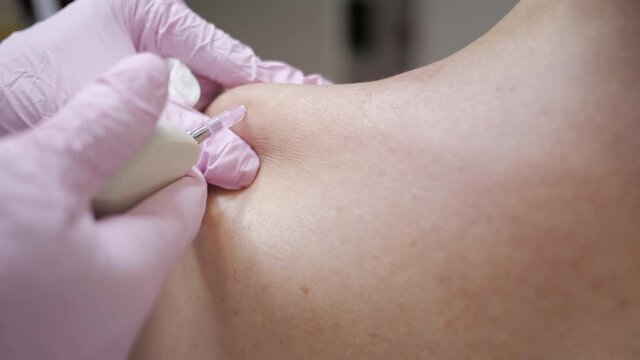 Close-up. Carbon dioxide carboxy therapy. Skin rejuvenation. Procedure is performed on patients shoulder