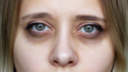 Cropped shot of a young female face. Green eyes with dark circles under the eyes and with red capillaries. Bruises under the eyes are caused by insomnia, fatigue, nervousness, lack of sleep and stress