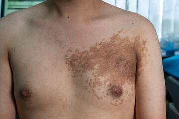 Young male with Becker’s nevus on the left upper chest 