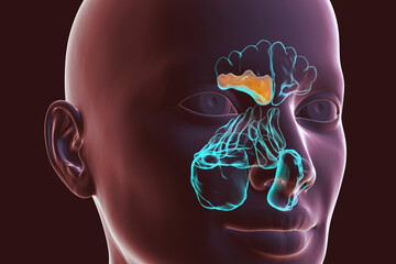 Sinusitis, inflammation of paranasal cavities