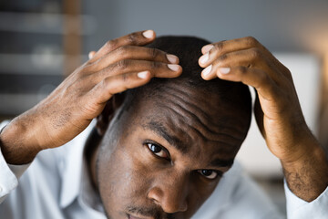 Young African Men Hair Loss