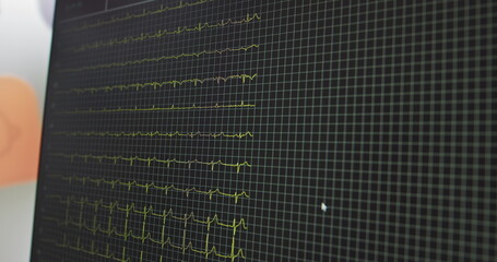 Heart rate monitor in hospital theater. Medical vital signs monitor instrument in a hospital on anesthesia surgery monitor. ECG. Patient heartbeat at the screen. Real Indicators. ECG or EKG screen.