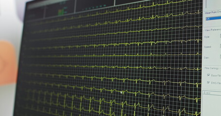 Heart rate monitor in hospital theater. Medical vital signs monitor instrument in a hospital on anesthesia surgery monitor. ECG. Patient heartbeat at the screen. Real Indicators. ECG or EKG screen.