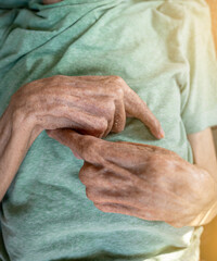 The elderly patient's hand is bent