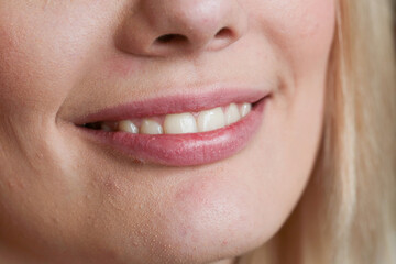 Charming snow-white smile of a girl close-up. Face with skin defects, sebaceous glands.