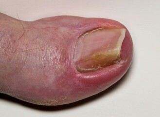 Ingrown toenail onychocryptosis on caucasian big toe Hallux, fungal infection tinea unguium closeup.