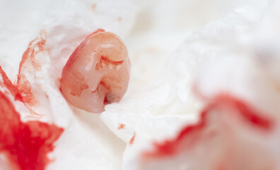 Close-up of a tooth covered in blood in a napkin.
