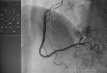 Coronary angiogram , medical x-ray for heart disease. Coronary artery disease.