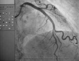 Coronary angiogram , medical x-ray for heart disease. Coronary artery disease.