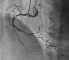 Coronary angiogram , medical x-ray for heart disease. Coronary artery disease.	