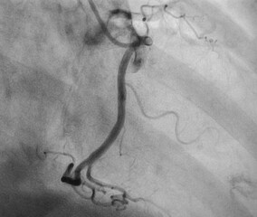 Coronary angiogram , medical x-ray for heart disease. Coronary artery disease.	