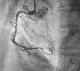 Coronary angiogram , medical x-ray for heart disease. Coronary artery disease.	