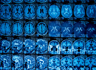 MRI scan of the brain. Magnetic resonance imaging scan