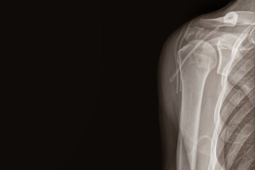 Xray image of shoulder isolated on black background. Chronic dislocation of the long biceps tendon after Operation. (reconstruction of the cranial third of the SSC tendon corkscrew anchor) 