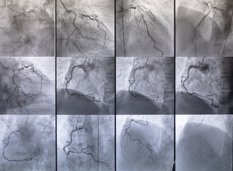 Coronary angiogram , medical x-ray for heart disease. Coronary artery disease.	