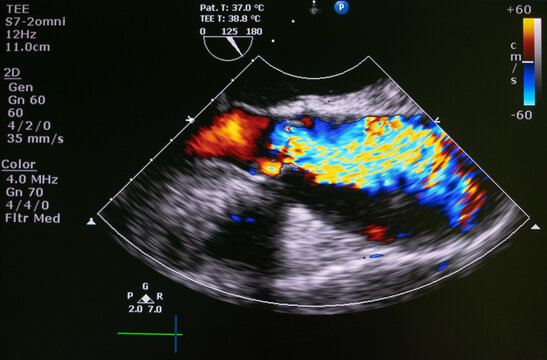 Echocardiography (ultrasound) machine. doppler of aortic stenosis