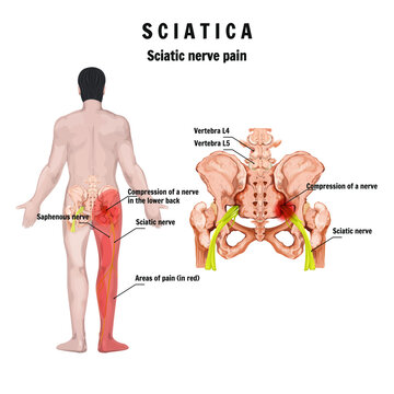 Sciatica – symptoms and causes, medical illustration of sciatic nerve. Neuropathy - sciatic nerve. Sciatic nerve dysfunction. LBP.
