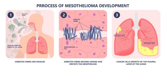 Asbestos breath chest pain testes ascites Hydrocele scrotum Swollen Difficulty fluid pleura testicle tunica vaginalis dust tract safe safety carcinogen smoking hazard danger tissue toxic silica copd