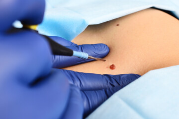 A dermatologist surgeon removes a neoplasm - a mole or nevus from the patient's abdomen with a radio wave knife. Aesthetic surgery, prevention of melanoma.