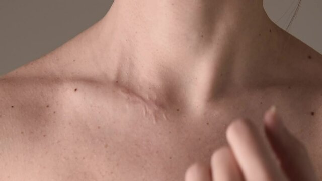 Close up shot of woman touching her surgical scar on collarbone near the neck.