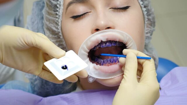 Professional dental hygiene procedure in dentistry. Doctor marking teeth. Modern stomatology. professional teeth scaling. Female patient in dental chair at dentist. teeth cleaning, 4 k video