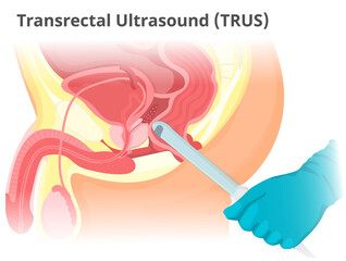 Illustration of the TRUS. Transrectal prostate ultrasound examination procedure