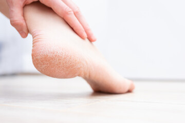The dry skin on the heel is cracked. Treatment concept with moisturizing creams and exfoliation for...