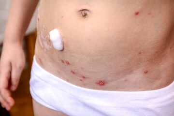 Therapy against the virus of Varicella has measles, chicken pox, rubella