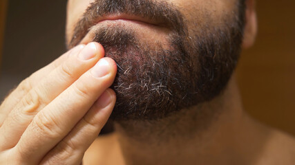 Detail of the man's chin with seborrheic dermatitis in the beard area. Dry skin peels off and...