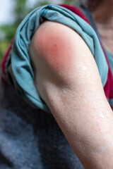 vaccine irritation on elderly woman's arm