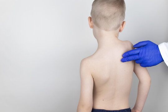 A little boy at the doctor's appointment with back pain. Treatment of spinal deformity and stoop. Osteoporosis, kyphosis, lordosis, or scoliosis.