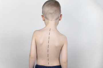 A little boy at the doctor's appointment with back pain. Treatment of spinal deformity and stoop....