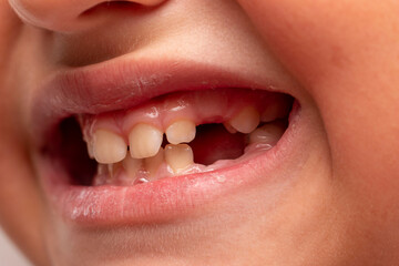 Fototapeta premium a baby's mouth with a missing milk tooth