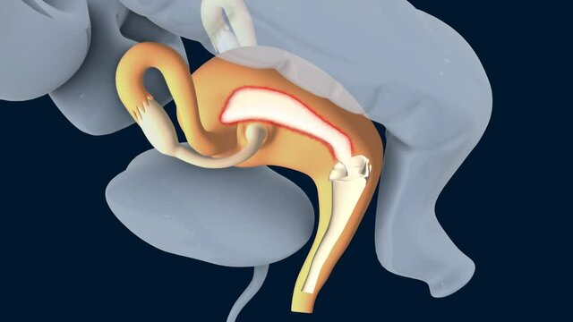 Endometriosis, female disease, where the layer of tissue is growing outside the uterus, 3d medical animation on dark background