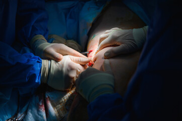 Phlebectomy operation. Surgical removal of veins