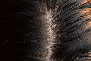 A Man with dandruff in dark hair, Top view Dandruff on the hair. Hair disease seborrhea. Fatty Dandruff.