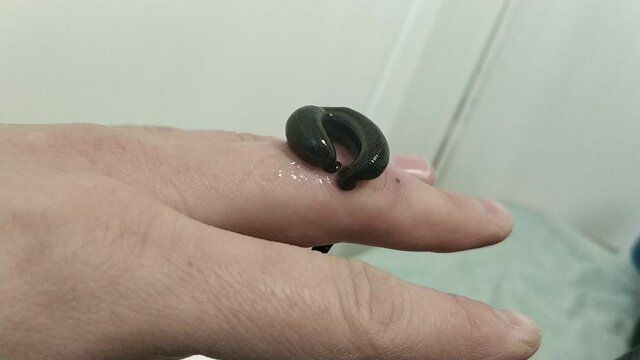 Treatment of a damaged finger joint with hirudotherapy. Leeches sucking blood on a human finger.