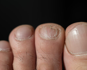 Close-up of male toes with a cracked nail
