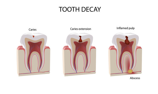 Tooth damage stages, realistic illustration, dental