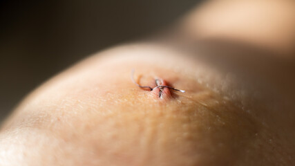 Close-up of a surgical suture after laparoscopic meniscus surgery.