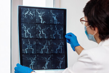 MRI scan of the arteries and blood vessels of the brain by computer tomography in the doctor's hands. Female doctor examining MRI scan of head of patient, holding in hands. Close up