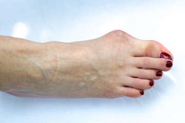 Closeup of a foot with hallux valgus isolated on white background, woman suffering from bunion in...