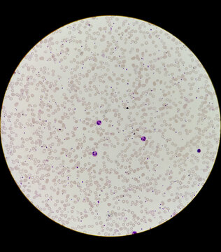 Blood film show leukopenia microscope 40 x objective and microcytic hypochromic anaemia