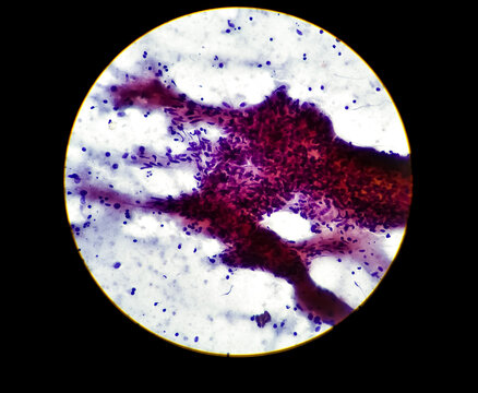 Mycobacterium tuberculosis in human supraclavicular lymph node FNAC slide cytopathology microscopic 40x view with E and H stain at medical laboratory.