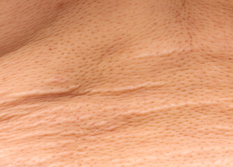 stretch marks on the skin in the form of stripes as a background