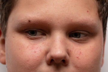 Obraz premium red spots on the face of a teenager with allergies