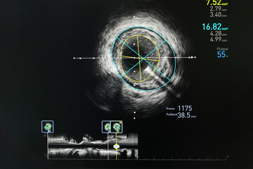 Intravascular ultrasound imaging (IVUS) at cardiac catheterization laboratory room.