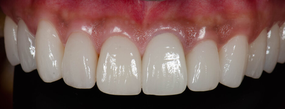 perfect smile with dental makeover treatment